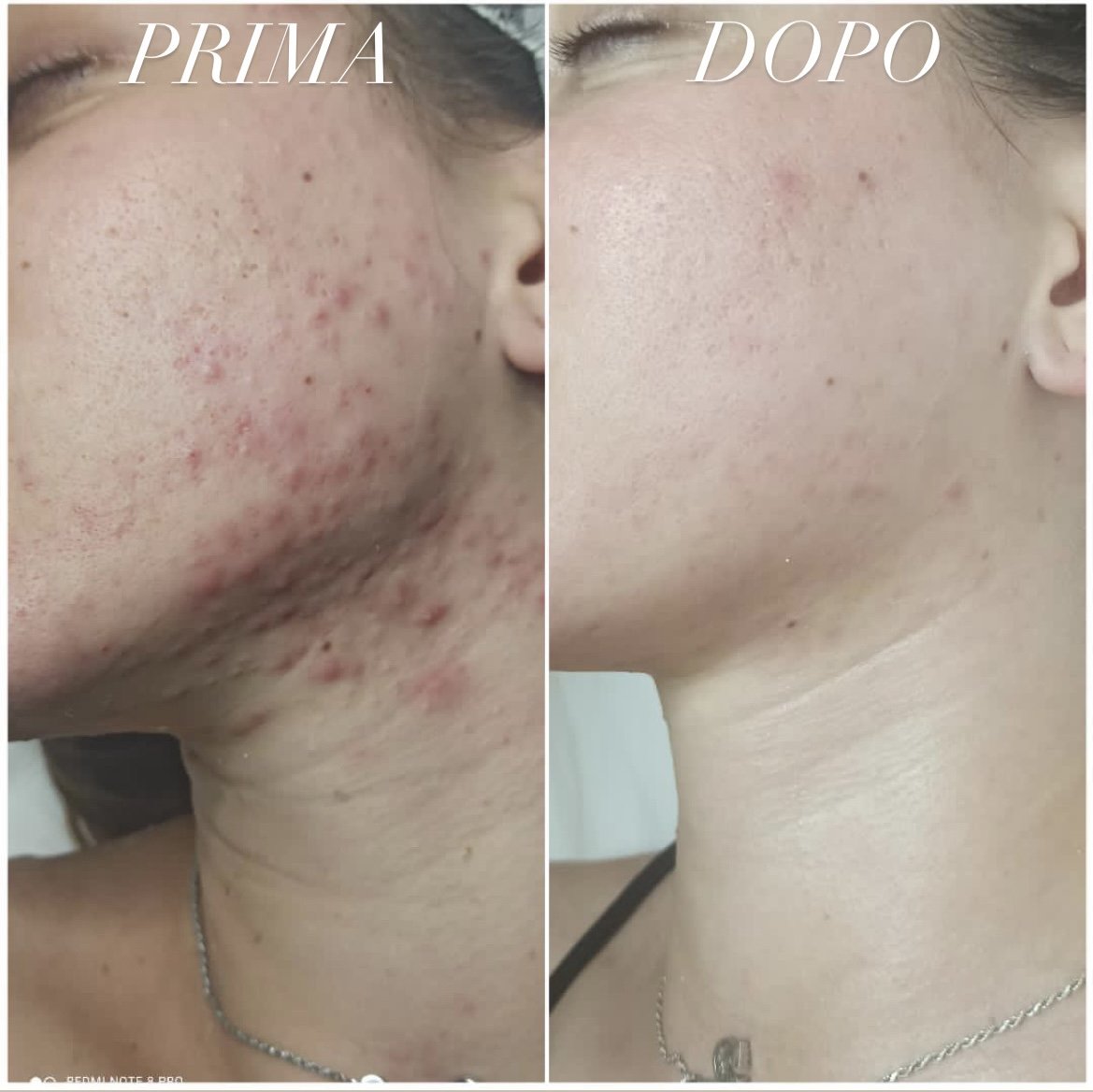 Prima e dopo, Percorso Anti-Impurità